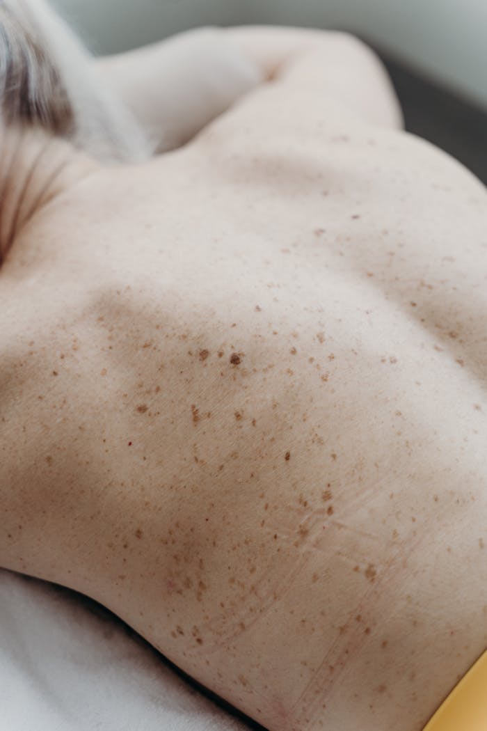 Close-up image of freckled skin and bare back, showcasing natural skin texture.